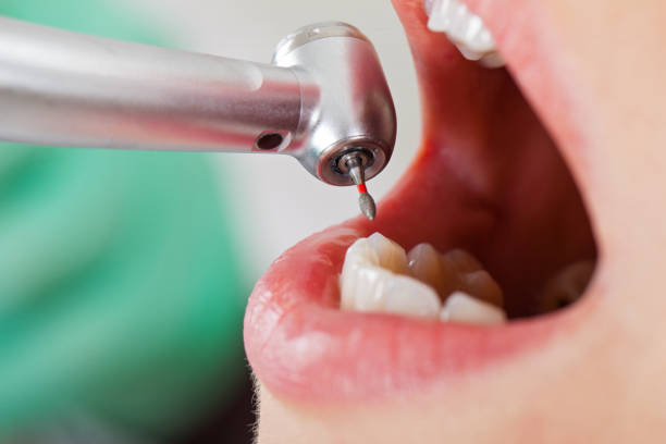 Best Emergency Tooth Extraction in Cheval, FL
